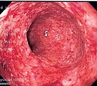 Ileita terminala (boala crohn)